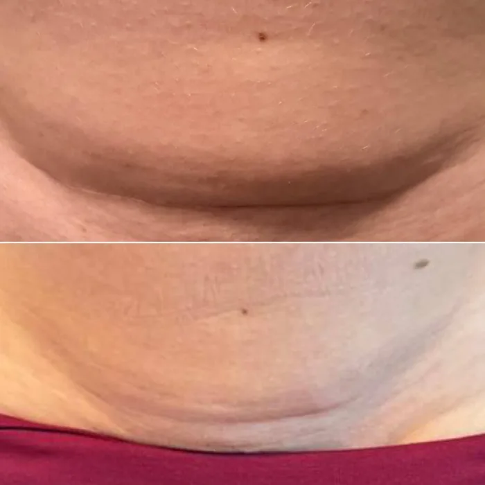 Antes (acima) e depois (abaixo) 3